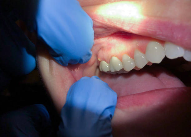 Best Tooth Infection Emergency Dentist  in Lincoln University, PA